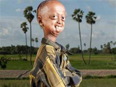 suffering from Progeria