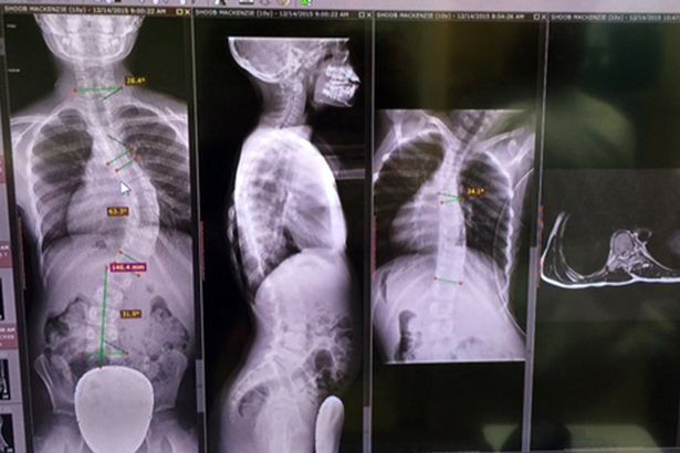 Schoolgirl Spine Was So Badly Twisted It Formed The Letter S