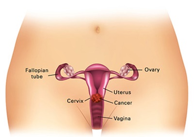 Every Woman Needs To Know About Cervical Cancer Symptoms